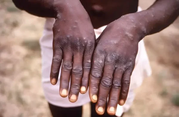 Surface of the hands of male African American Monkeypox case during the recuperative stage. Monkeypox can have lasting effects on its victims even after being cured such as the presence of permanent skin marks. “I can't imagine having bumps on me because that's gross,” said Muñoz.